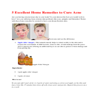 5 Excellent home remedies to cure acne