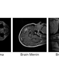 Brain Cancer Classification