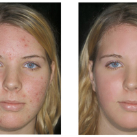 Remove imperfections