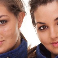 Skin smoothing spots removed