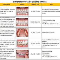 Internet Research - Dental Braces